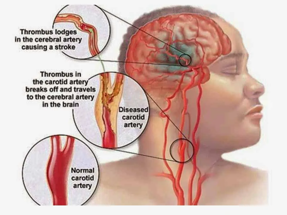 Instrument Invented by Indian to help Paralytic Patients